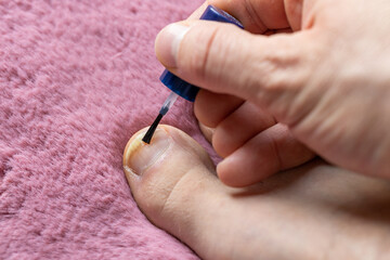 onychomycosis, the initial stage of ringworm. Painting the big toe with medicated varnish, Background pacific pink