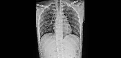 A photo of plain radiograph on dark background in hospital. The film use for diagnosis the illness of patient.Medical concept. A man with normal chest x-ray.