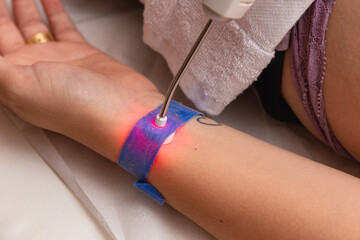 Treatment using an ilib wrist brace.