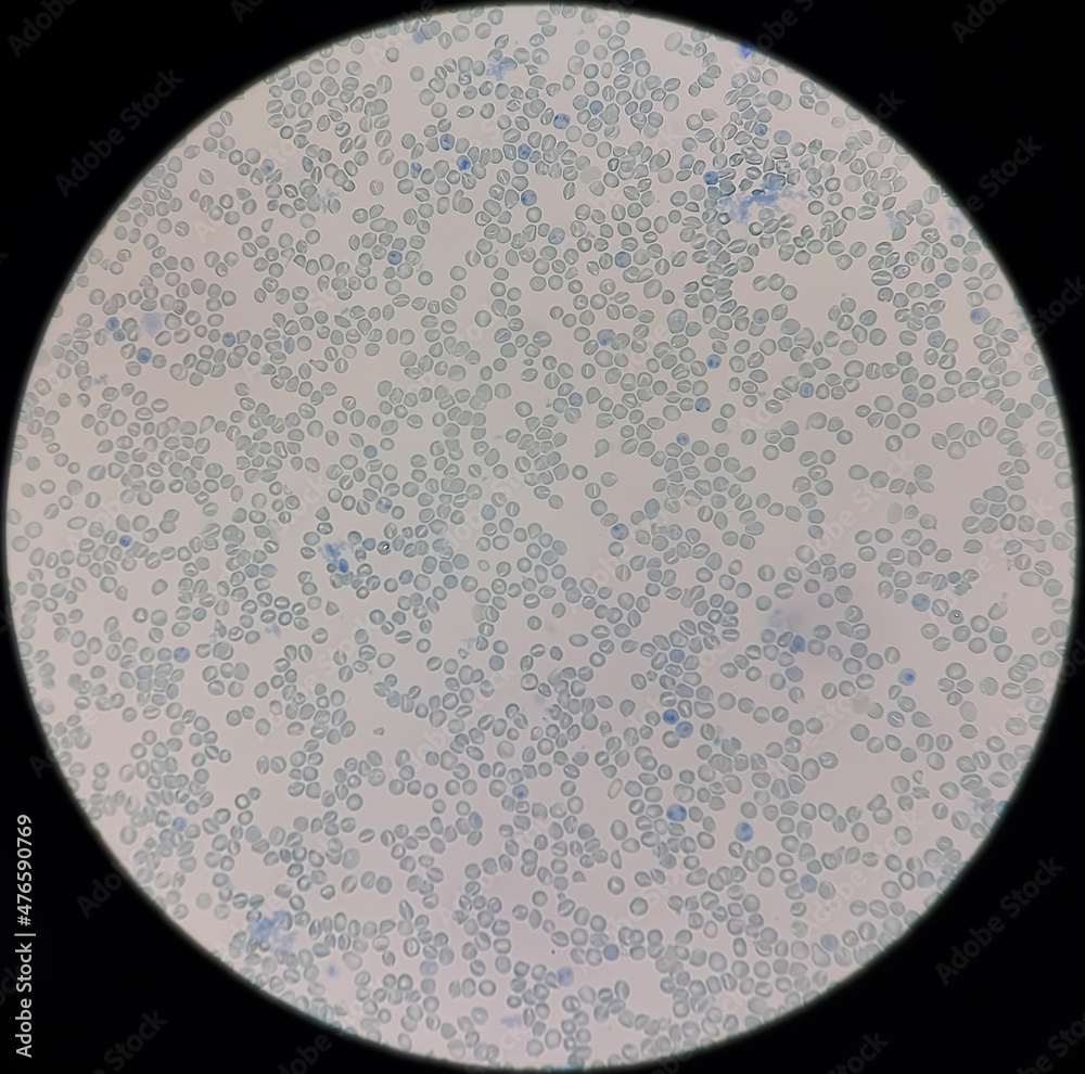 Poster Reticulocyte count under microscope, 100x. methylene blue staining,reticulocyte count from blood smear