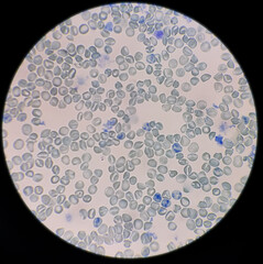 Reticulocyte count under microscope, 100x. methylene blue staining,reticulocyte count from blood...