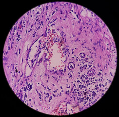 Ear and mastoid(biopsy): Microphotograph of Cholesteatoma, show keratinized stratified squamous epithelium with granulation tissue and keratin debris, chronic inflammatory infiltrate