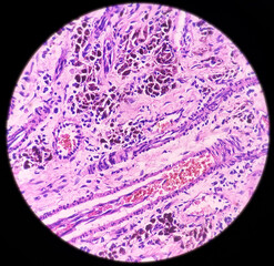 Ear and mastoid(biopsy): Microphotograph of Cholesteatoma, show keratinized stratified squamous epithelium with granulation tissue and keratin debris, chronic inflammatory infiltrate