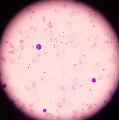 Leishman's stain microscopic show Leuco-erythroblastic anemia with thrombocytopenia, severe anemia,...
