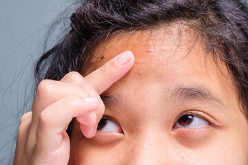 Closeup acne pimple on the forehead of child, eleven years old girl has the pimples on skin for the first time