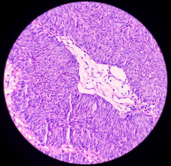Urinary bladder cancer: microphotograph transitional cell carcinoma, high grade, malignant...