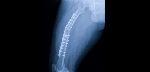 A hip and thigh x-ray showing closed fracture at shaft of right femur. The patient has fixation with plate and screws. The image shows implant failure or broken plate at the fracture site. - obrazy, fototapety, plakaty