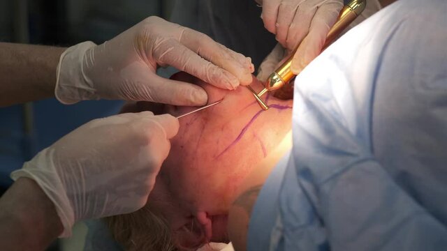 Beginning of plastic surgery for platysmoplasty to lift the neck and chin. Doctor and his assistant marked the patient's skin. Doctor inserts a long surgical needle into the patient's skin to perform 