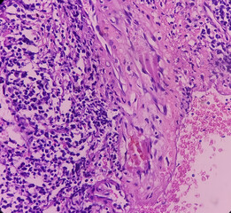 Pyriform fossa cancer: Invasive squamous cell carcinoma, moderately differentiated, show malignant neoplasm composed atypical squamous epithelial cells.