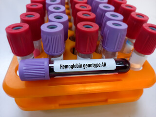 Blood sample tube with blood for Hemoglobin genotype AA test, hemoglobin evaluation, sickle cell screen.