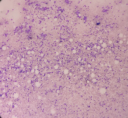 Microscopic view of bone marrow slide, acute myeloid leukemia(AML), type of blood cancer in which the bone marrow makes abnormal myeloblasts.