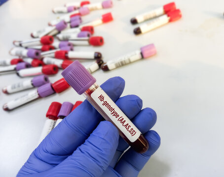 Blood Sample Tube With Blood For Hemoglobin(Hb) Genotype AA,AS,SS-test, Hemoglobin Evaluation, Sickle Cell Screen.