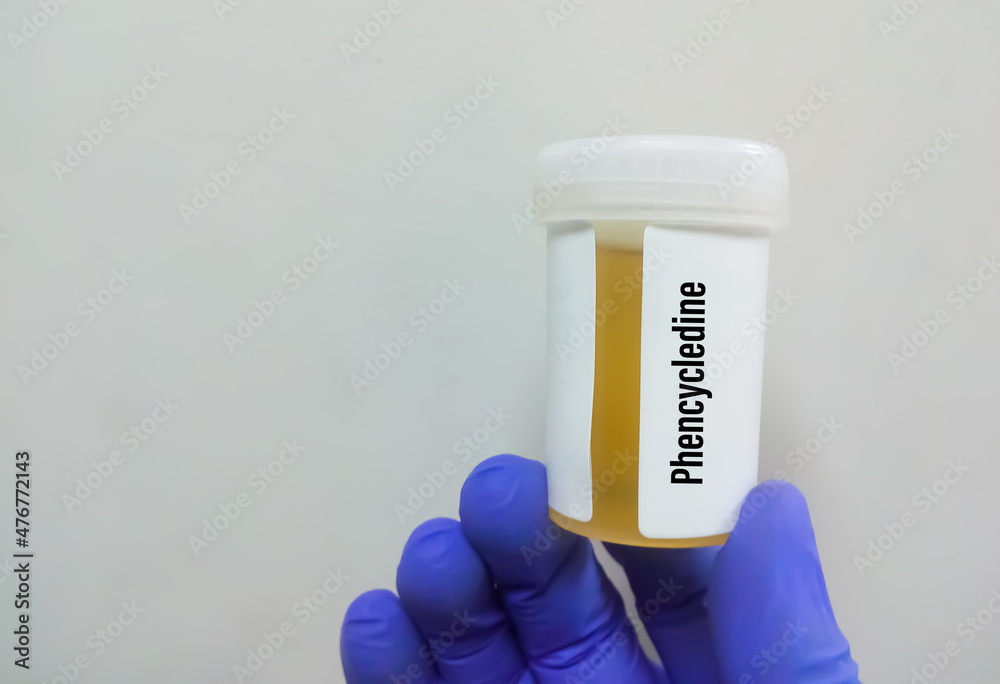 Poster Medical laboratory urine container with urine sample for drugs test phencyclidine. Diagnosis of illegal drug phencyclidine in urine.