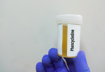 Medical laboratory urine container with urine sample for drugs test phencyclidine. Diagnosis of...