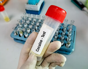 Medical laboratory urine container with urine sample for drugs test Cocaine. Diagnosis of illegal...
