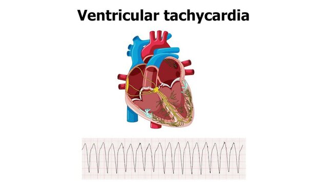 heart animation ventricular tachycardia (VT) with ecg