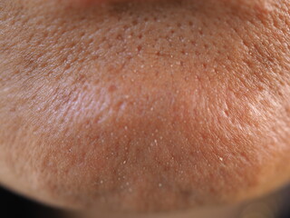 Fototapeta premium Asian woman has skin problem, large pores, whitehead and blackhead pimple. closeup photo, blurred. 