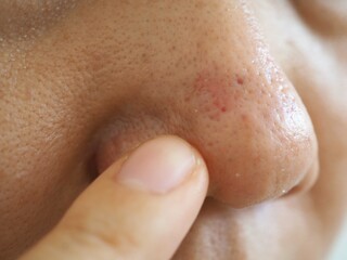Fototapeta premium Woman pointing to red acne marks on nose. closeup photo, blurred.
