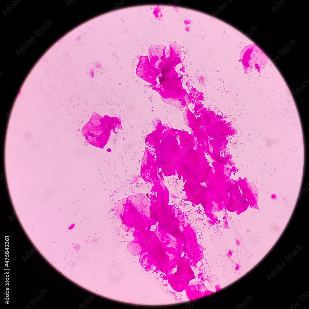 Wall mural High Vaginal Swab (HVS): gram stained microscopic view of epithelial cells with gram positive Diplococci bacteria and few gram negative rods shape bacillus, Streptococcus, Staphylococcus