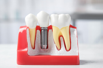 Educational model of gum with dental implant between teeth on white table indoors