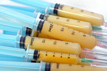 stack of syringes filled with breast milk collected by a breast pump prepared for feeding an...