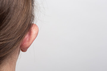 Female lop-eared protruding ear rear view on a light background. Otoplasty, plastic of the auricle