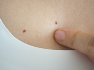 Woman points a finger at a small mole on her chest. closeup photo, blurred.