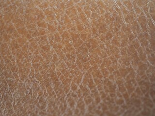 Dry skin, flaky skin. skincare concept. closeup photo, blurred.