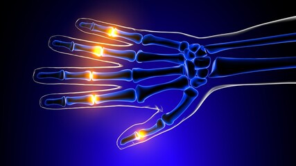 Proximal interphalangeal joints pain Anatomy For Medical Concept 3D © mybox