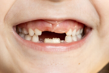 Close-up of a 6-7 year old girl with newly erupting teeth. Loss of milk teeth. new teething