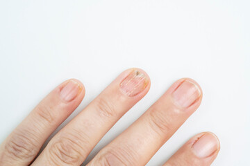  nail fungus infection on hand finger of white woman