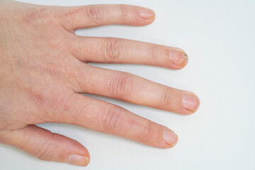  nail fungus infection on hand finger of white woman