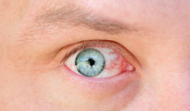 Redness of the eyes in humans. Inflamed conjunctiva of the eyeball. Fury in the eyes of a man.