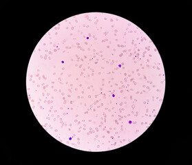 Photomicrograph of Leuco-erythroblastic anemia. 40X