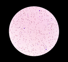 Photomicrograph of Leuco-erythroblastic anemia. 40X