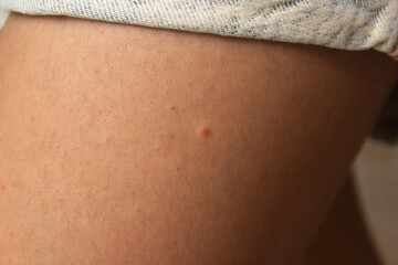 small red spot on a woman's skin