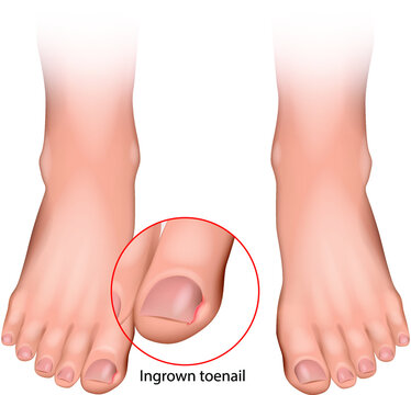 Ingrown toenail  or onychocryptosis that occurs when the nail edge grows into the periungual dermis. Nail disease. Vector illustration.
