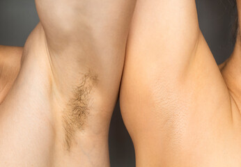 Two armpits with and without hair. Laser hair removal concept. - obrazy, fototapety, plakaty