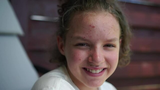 Close up portrait of a smiling bright teenage girl with teenage rashes and acne on the face. Face close-up