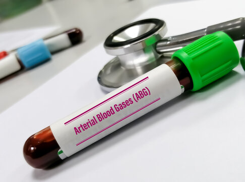 Blood Sample Tube For Arterial Tblood Gas Analysis