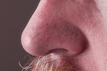 the surface of the skin on the nose in rosacea and eczema