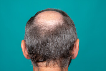 A closeup of a half-bald male head, hair transplant concept for hair loss - obrazy, fototapety, plakaty