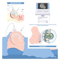 Spina bifida Pregnancy non invasive neural tube gene AFP NTD infant cord folate folic acid serum level sacral dimple child Lumbar birth NIPT test fetus born baby spine blood fluid villus alpha