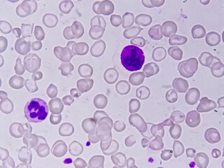 Blood smear leishman stained Microscopic show zooming image of hereditary haemolytic anemia also...