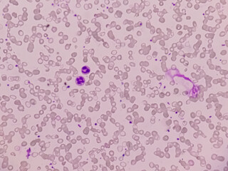 Blood smear leishman stained Microscopic show zooming image of hereditary haemolytic anemia also...