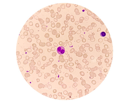 Blood smear leishman stained Microscopic show zooming image of hereditary haemolytic anemia also called Thalassemia and thrombocytopenia.