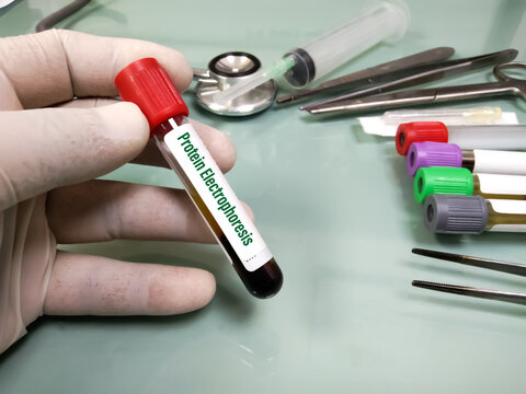 Blood sample for Protein Electrophoresis test with laboratory background. Concept of science, laboratory and study of diseases.
