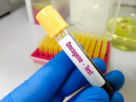 Blood sample tube for Oncogene test at medical laboratory. To diagnosis  cancer gene