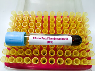 Blood sample tube for Activated Partial Thromboplastin Ratio (APTR) test at medical laboratory. To...