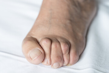 Bunion on foot of senior man with hammer toes and dry skin over white background. Hygiene, surgery, health care, podiatrist, dermatology concepts - obrazy, fototapety, plakaty